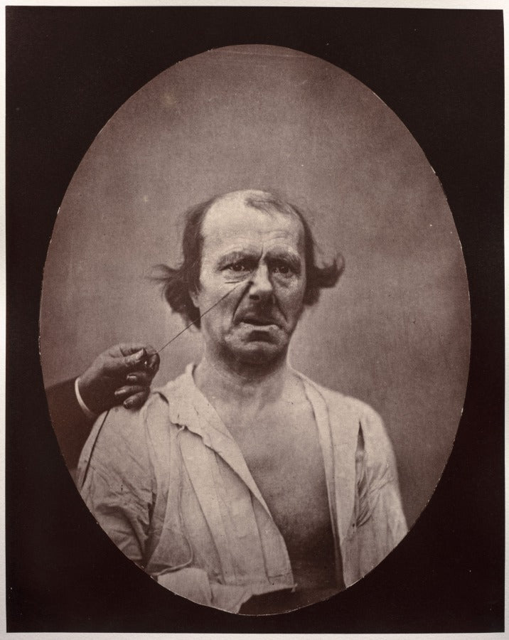 Figure 51  droite, contraction partielle de l'lvateur commun de l'aile du nez et de la lvre suprieure mcontentement, mauvaise humeur  gauche, repos by Guillaume-Benjamin-Amand Duchenne (de Boulogne) (French, 1806–1875) - Classic Art canvas print