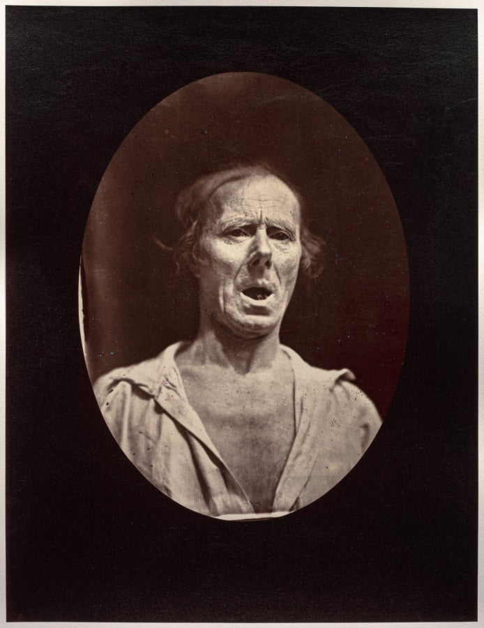 Figure 54 Abaissement volontaire de la mchoire infrieure mouvement inexpressif by Guillaume-Benjamin-Amand Duchenne (de Boulogne) (French, 1806–1875) - Classic Art canvas print