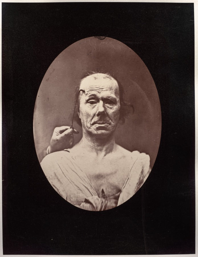 Figure 7 tude du mchanisme et de l'expression du muscle frontal chez un vieillard  droit, attention  gauche, repos by Guillaume-Benjamin-Amand Duchenne (de Boulogne) (French, 1806–1875) - Classic Art canvas print